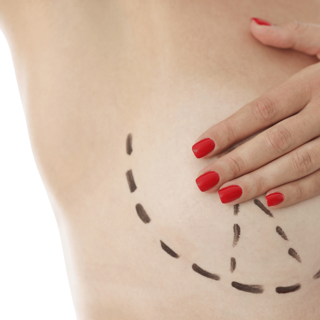 Close-up of a person's chest with red-painted nails, showing marked lines on the skin, indicating surgery or medical procedure preparation.