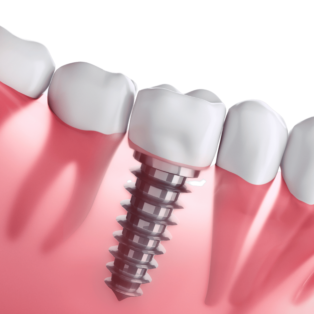 Illustration of a dental implant in gums, showing a metal post positioned beneath a crown, surrounded by natural teeth.