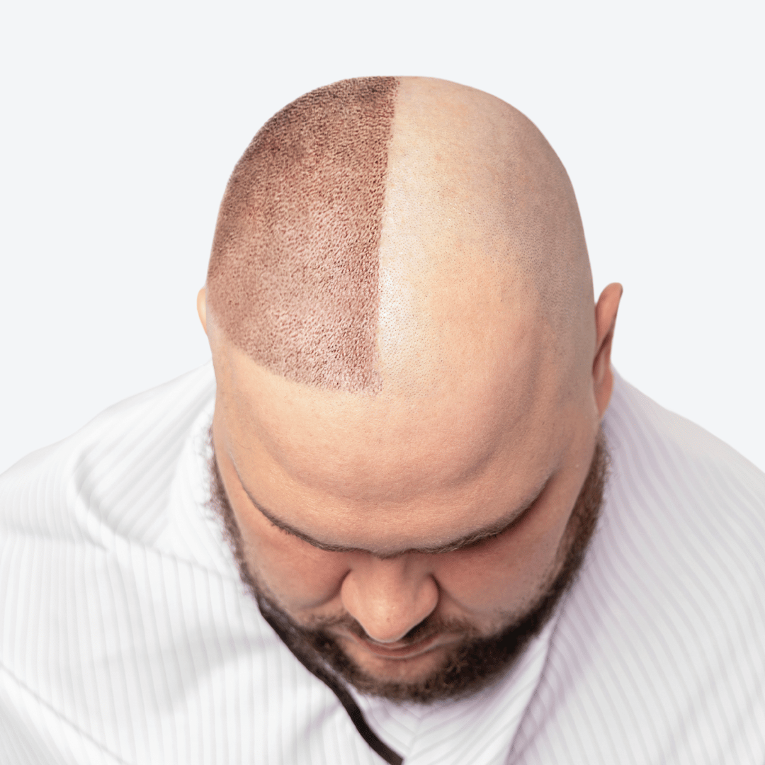 A man with a shaved head is seen from above, showcasing a hair transplant on the left side and baldness on the right.