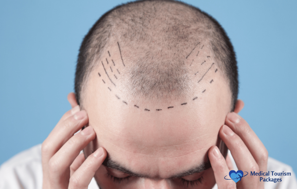 A person with a marked scalp for hair implants, hands resting on their head, ready to embrace a new look after following a comprehensive guide.