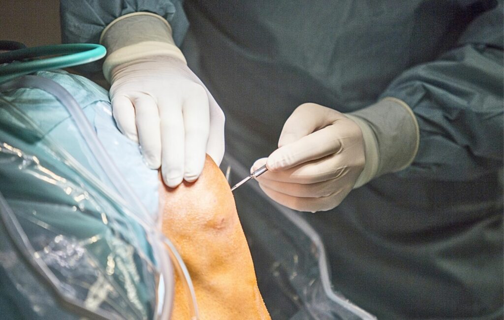 Primer plano de un procedimiento quirúrgico que muestra unas manos enguantadas realizando una inyección precisa en la rodilla de un paciente, con paños quirúrgicos azules estériles cubriendo la zona circundante, demostrando técnicas ortopédicas mínimamente invasivas.