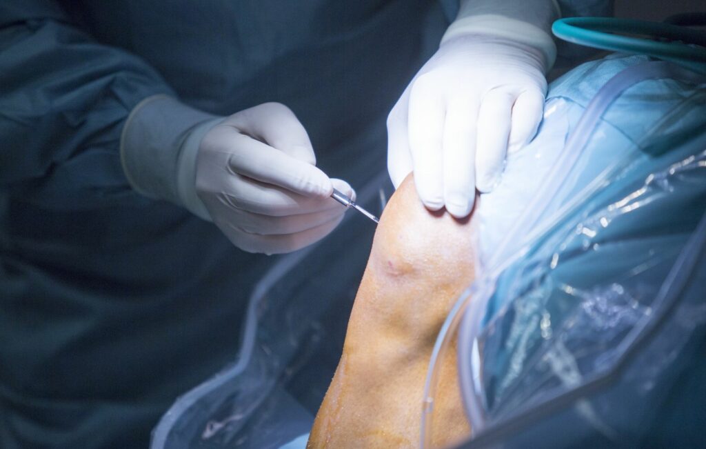 Fotografía médica en primer plano de las manos enguantadas de un cirujano realizando una operación de rodilla, con un paño azul estéril visible y la colocación precisa de los instrumentos, iluminado por una luz quirúrgica brillante sobre un fondo oscuro.