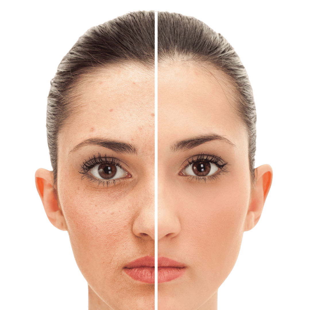 Split image of a woman's face showing skin with acne and texture on the left side, and smooth, clear skin on the right side.