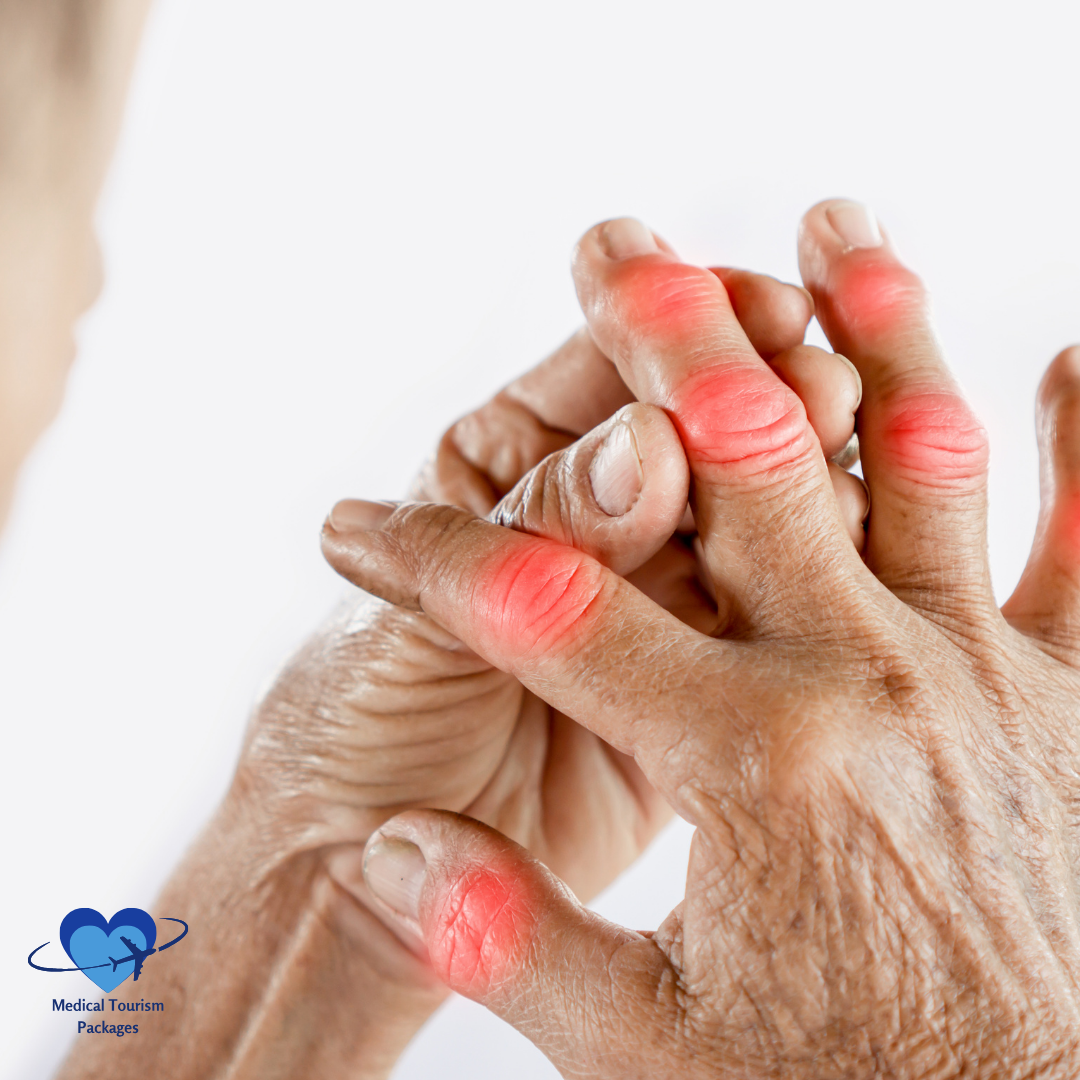 Close-up of hands with inflamed joints, highlighting redness and swelling typically associated with arthritis. Regain mobility and improve quality of life by exploring various treatments that can alleviate discomfort and restore function.