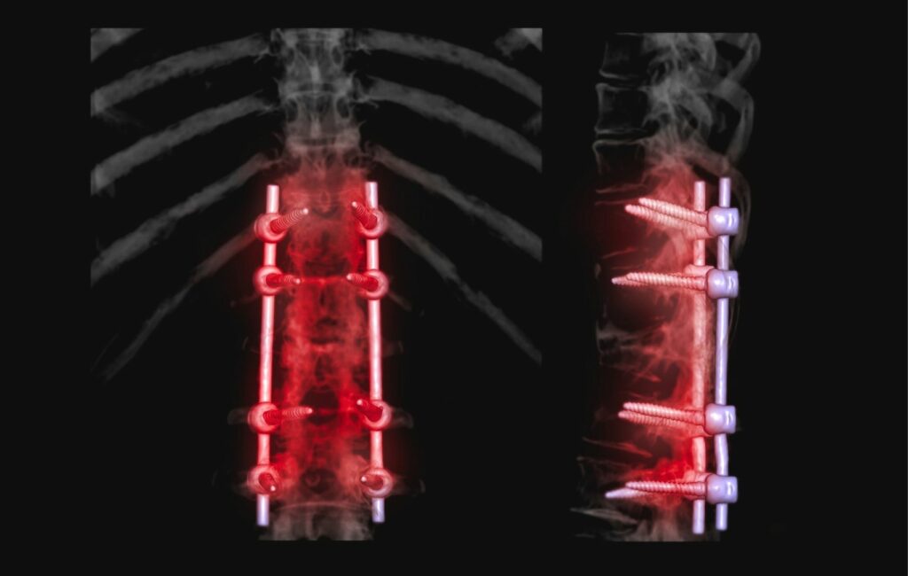 Imagen de rayos X de vista dual de una columna vertebral con hardware quirúrgico, que muestra perspectivas frontales y laterales de vértebras con barras metálicas, tornillos y dispositivos de estabilización resaltados en rojo brillante utilizados en la cirugía de fusión espinal sobre un fondo negro.