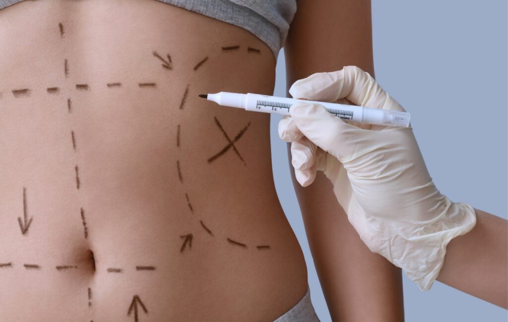 A person's abdomen is marked with surgical lines as they wear a grey top, a gloved hand poised with a marker pen, indicating areas for abdominoplasty procedures in Panama.