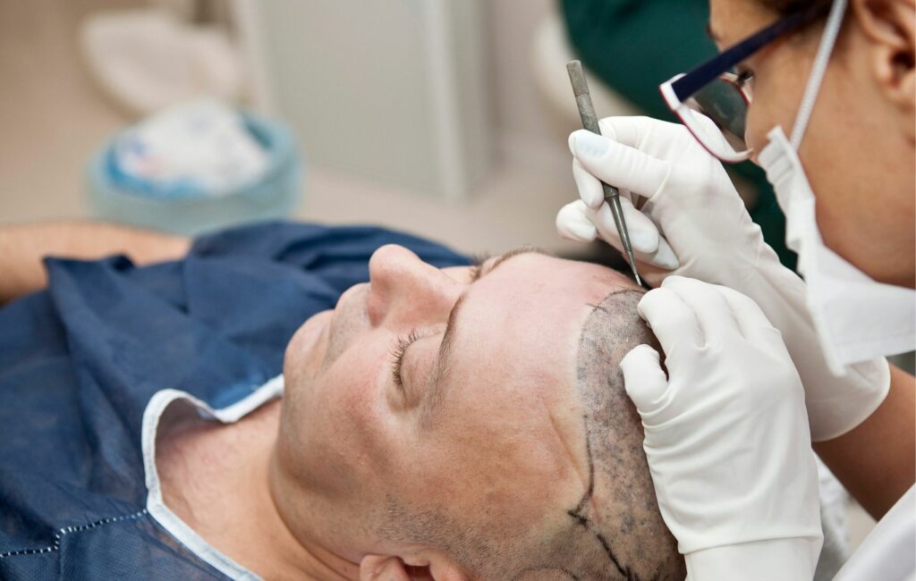 A person undergoing a hair transplant procedure, with a medical professional utilizing cutting-edge techniques and precision tools for effective hair restoration.